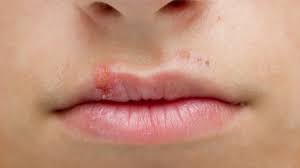 Wie lange ist er ansteckend? Lippenherpes Behandlung Verlauf Ursachen Onmeda De