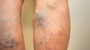 .prevalence of varicose veins and chronic venous insufficiency in men and women in the general 100. Dealing With Varicose Veins Vascular Health Clinics