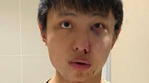 Student hit by attacker who said: 'I don't want your coronavirus in my  country'