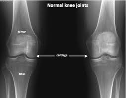 Image result for Knee XRay