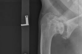 Those are all classic signs. Total Shoulder Replacement Fitzpatrick Referrals