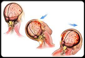 Brain injuries are typically either open or closed. Traumatic Brain Injury Car Accident Doctor