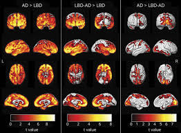 β-Amyloid PET and neuropathology in dementia with Lewy bodies | Neurology