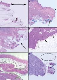 In breast cancer what do the n levels mean? Surgical Margins In The Veterinary Cancer Patient Milovancev 2017 Veterinary And Comparative Oncology Wiley Online Library