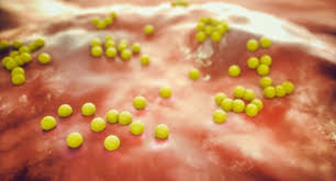 In some cases, it causes pneumonia (lung infection) and other infections. Mrsa Keime Nutzen Eine Tarnkappe Protein Macht Die Erreger Fur Die Immunabwehr Unsichtbar Scinexx De
