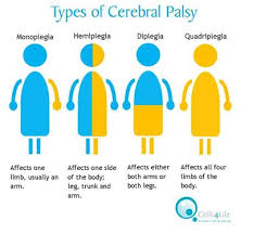 I have been writing i have been finished. Feeding The Child With Cerebral Palsy A Speech Therapists Perspective Physiopedia