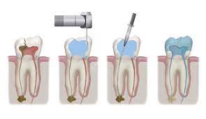 Root Canal Therapy Valdosta Ga Advanced Dental Care