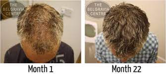 Hair dyes that lighten hair from its natural color are the most disruptive as they contain high volumes of peroxide. Hair Colour And Hair Loss