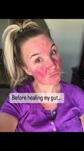 Comment "GUT" and I'll send you the deets. , I wish I had discovered this  sooner…I struggled with my skin for almost a decade and I had no clue my  skin issues were linked to my gut health. In fact ...