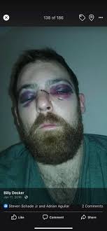 In 2009, Ian Laperriere took a slap shot to the face late in the first  period of the game against the Buffalo Sabres. He lost seven teeth, broke a  bone above his