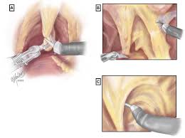 Image result for Radical Prostatectomy