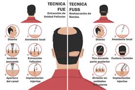 Cuántos injertos capilares