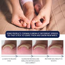 Image result for Paronychia feet