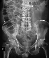 The small intestinal loops are predominantly central in the abdomen and can be recognized by their circular mucosal folds, also known as kerckring folds / circular folds (fig. Abdominal X Ray Interpretation Axr Radiology Osce Geeky Medics