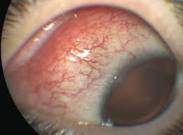 Eyeing A Dx Of Iois Presentation Diagnosis And Treatment