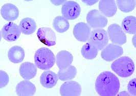 Die malaria tropica verläuft in der regel schwerer als die anderen formen, komplikationen und todesfälle kommen fast nur bei dieser form vor. Mikropraparat Plasmodium Falciparum Erreger Der Malaria Tropica Menschen