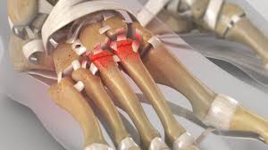 Diagnosis is confirmed by radiographs which may show widening of the interval between the 1st and 2nd ray. Lisfranc Midfoot Injury Md West One