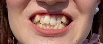 Dentistry Journal | Free Full-Text | Supernumerary Tooth Patterns In  Non-Syndromic White European Subjects