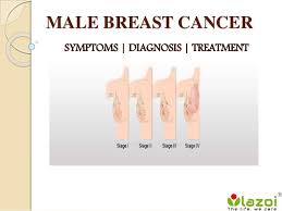 The areola is the darkened and pigmented ring. Male Breast Cancer Symptoms Diagnosis And Treatment
