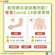 Lancet火速在1/24刊出兩篇文章，其中一篇題目為clinical features of patients infected with 2019 novel coronavirus in wuhan, china，此篇文章整理了最初41名 個案的臨床表現包含症狀學、影像學、以及臨床檢驗. çš®è†šèµ·ç´…ç–¹å¯èƒ½æ˜¯æ–°å† è‚ºç‚Ž é†«å¸« ç•™æ„5å¤§çš®è†šç—‡ç‹€ ä»Šå¥åº·