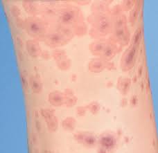 Image result for Erythema Multiforme Causes