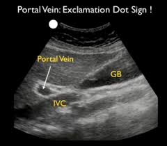 Saat saya bilang ada batu empedu sebesar 2.5 cm, dokter usg, dan ajaib, katanya, kantongnya bersih, enggak ada batu. Biliary Ultrasound Docnesia Com