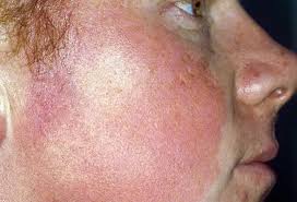 Image result for Keratosis pilaris