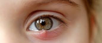 как лечить ячмень на нижнем веке в домашних условиях Yachmen Na Glazu Kak Vylechit V Domashnih Usloviyah