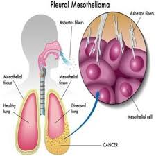 Asbestos is a material that people have used as insulation since the industrial revolution. Asbestos Related Lungs Diseases 9 Fig 8 Mesothelioma 10 Fig 9 Lung Download Scientific Diagram