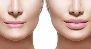 Exactly how long the injections last varies slightly from person to person depending on individual factors like how much volume you opt for with. Will My Lips Return To Their Original Shape After Restylane Kysse Vein Laser Institute
