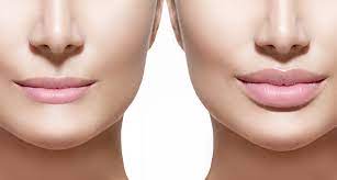 This is also normal and will subside in a few days. Will My Lips Return To Their Original Shape After Restylane Kysse Vein Laser Institute