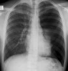 Radiology Signs Unilateral Hyperlucent Hemithorax When One Side Radiology Radiographer Radiography