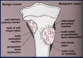 Benign bone tumors are noncancerous growths in or on bones. Pin On Health