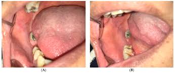 Image result for Leukoedema