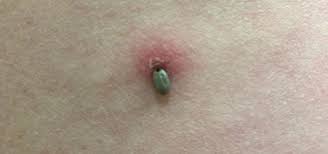 Image result for infected tick bite