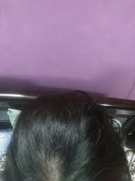 Hair loss associated with vitamin deficiencies is almost always reversible. Hair Fall Due To Vitamin D Deficiency Is There Any Chances Of Regrowth Of Hair Photos