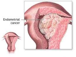 Like any type of cancer, the earlier it's detected, the better your outcome will likely be. Postmenopausal Bleeding Not A Sign Of Endometrial Cancer In Most Women