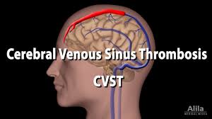 We did not find results for: Trombosis Venosa Cerebral Despues De La Vacunacion Sars Cov 2 Noticias Medicas Intramed