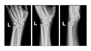 Image result for Scapholunate Dislocation