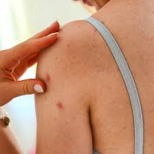 Breast cancer is the second most common cancer found in women — after skin cancer — but that doesn't mean men aren't at risk as well. Getting A Clear Picture Of Skin Cancer