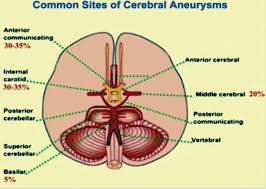 Aneurysmal Subarachnoid Hemorrhage Intechopen Read more about brain aneurysm symptoms and treatment options available at upmc, a world a brain or cerebral aneurysm is a cerebrovascular disorder that is caused when the wall of an artery in.