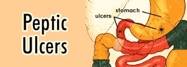 Image result for peptic ulcer