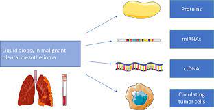 Find updated content daily for is mesothelioma cancer. Circulating Biomarkers In Malignant Pleural Mesothelioma