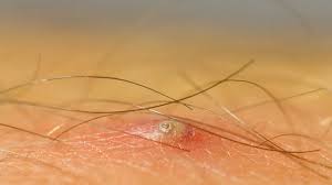 Sometimes, the skin surrounding the area might grow darker as. Ingrown Hair On Penile Shaft Removal Identification And Causes