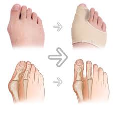 Aksi mereka adalah jari di fiksasi anatominya, yaitu keadaan. Ibu Jari Kaki Valgus Orthosis Jempol Kaki Dukungan Liners Bunion Silikon Ortopedi Brace Koreksi Separator Tinggi Tumit Kaki Nyeri Tulang Perawatan Kaki Alat Aliexpress