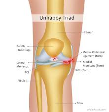 Unhappy Triad Jpg 1 200 1 234 Pixels Sports Injury Knee Joint Knee Injury