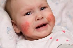 Tak ada keje nak kumpul ayaq liuq. Apa Itu Ruam Air Liur Bayi Dan Bagaimana Cara Mencegah Dan Mengatasinya Pure Premium Care