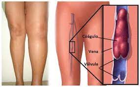 Afecta principalmente las venas grandes en la parte inferior de la pierna y el muslo, pero puede presentarse en otras venas profundas, como en los brazos y la pelvis. 5 Cosas Que Puedes Hacer Para Prevenir La Trombosis Mejor Con Salud