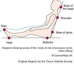Pressure Points Soreness Pressure Prevention