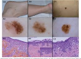 Melanoma in its early stages may presents as: Pdf Early Stages Of Melanoma On The Limbs Of High Risk Patients Clinical Dermoscopic Reflectance Confocal Microscopy And Histopathological Characterization For Improved Recognition Semantic Scholar